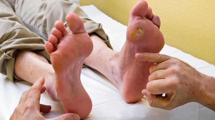 market-of-diabetic-foot-ulcer-treatment-by-the-end-of-2025-a-analysis