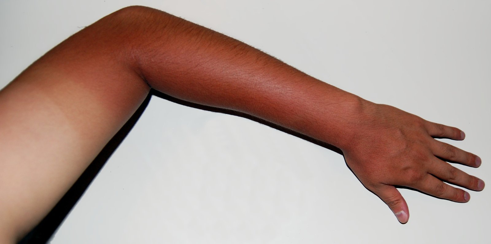 vitamin-d-may-improve-sunburn